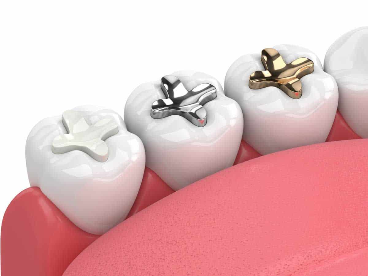 Tooth Filling in Dubai